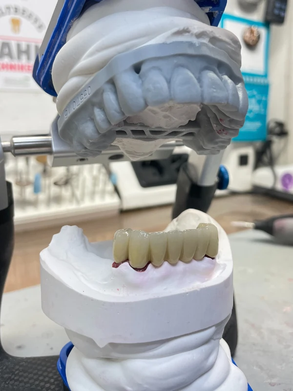 Dentallabor Hamburg-Zimbelmann-Zahntechnik - Keramik